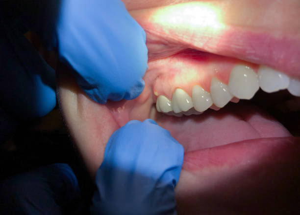 Best Emergency Dental Filling Replacement  in Sconsin Dells, WI